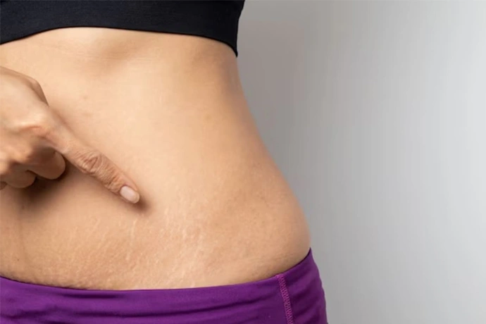 stretch mark